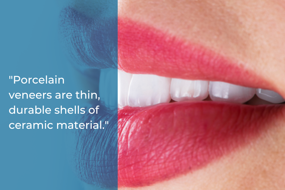 Close-up of a woman's smile showing white teeth, with text overlay describing porcelain veneers as thin, durable ceramic shells that can cover stained teeth or chipped teeth for a flawless look.
