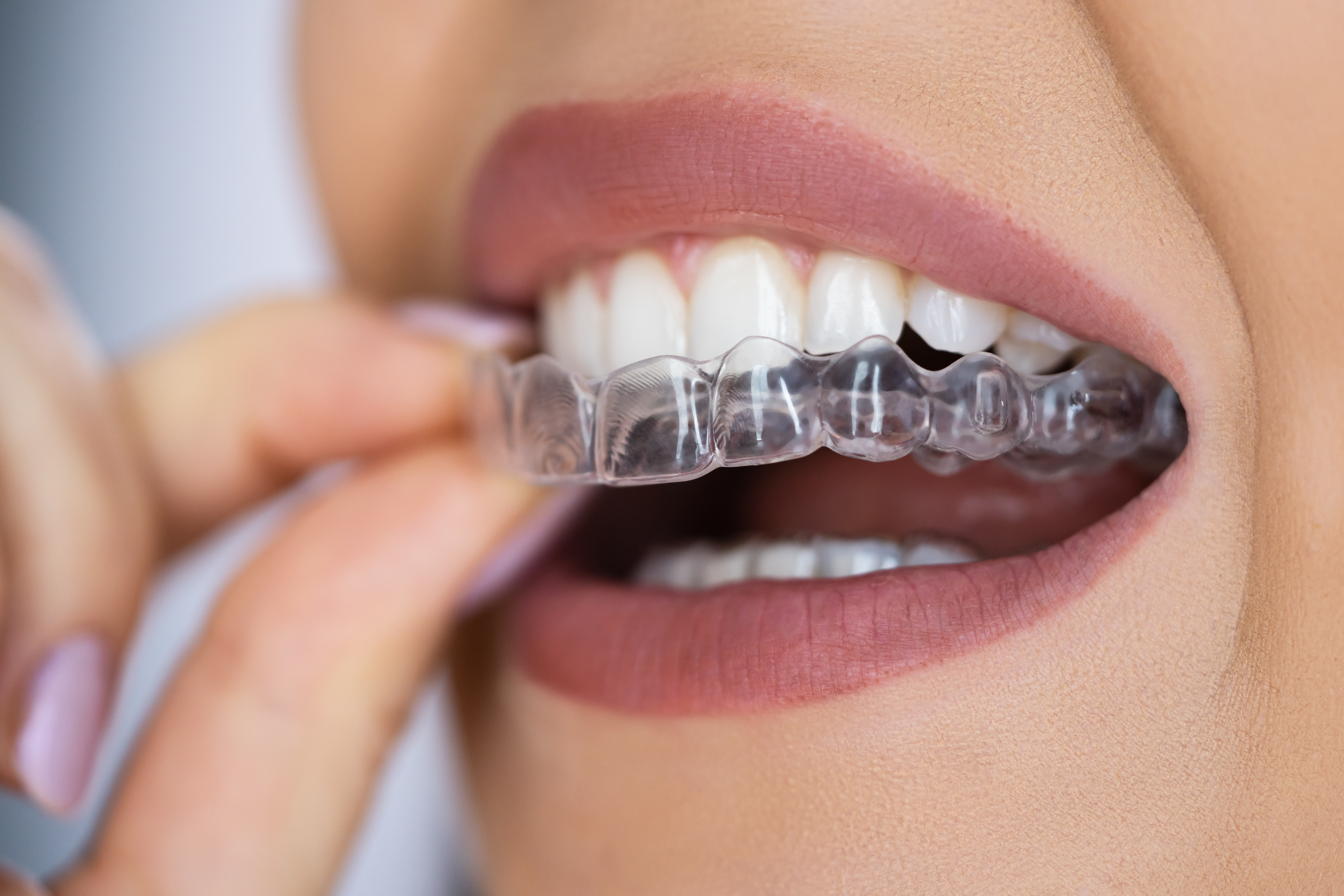 Woman inserting a clear aligner tray over her teeth